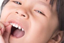 Gigi Berlubang Bisa Ganggu Nafsu Makan Anak, Pemeriksaan Rutin Jadi Kunci