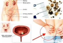 7 Kebiasaan dan Kondisi yang Diam-Diam Memicu Batu Ginjal pada Perempuan