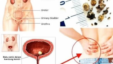 7 Kebiasaan dan Kondisi yang Diam-Diam Memicu Batu Ginjal pada Perempuan