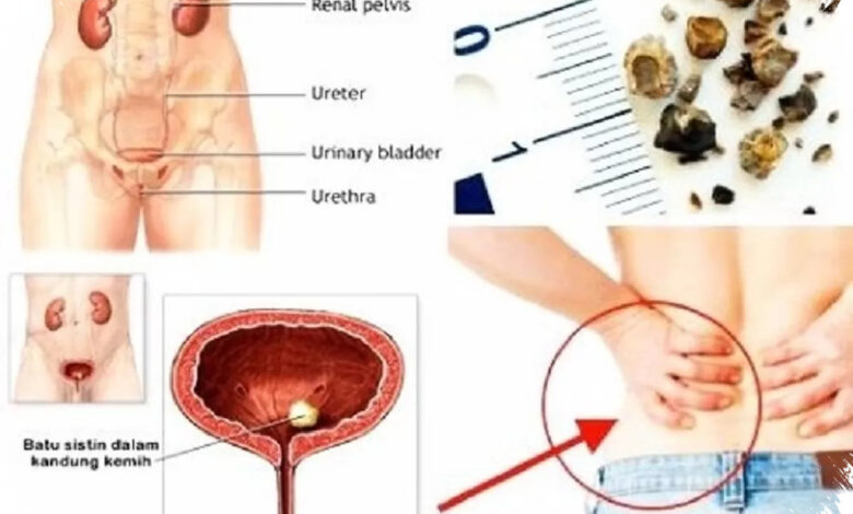 7 Kebiasaan dan Kondisi yang Diam-Diam Memicu Batu Ginjal pada Perempuan
