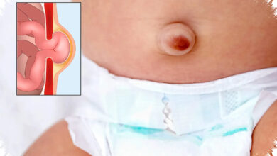 Benjolan Kecil di Selangkangan Anak Bisa Berbahaya, Hernia Tak Sembuh Sendiri