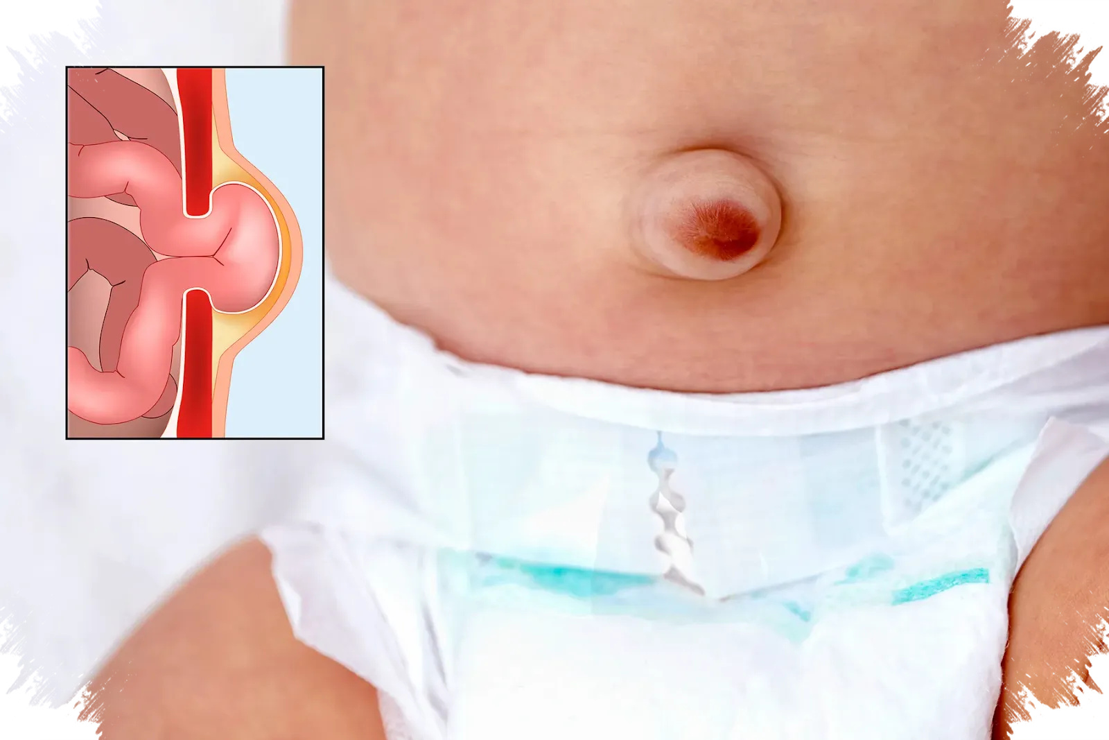 Benjolan Hilang-Timbul di Paha atau Pusar Anak Bisa Jadi Hernia, Ini Tanda Bahayanya