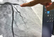 Lesi Bifurkasi Bikin Pemasangan Ring Jantung Lebih Rumit, Ini Alasan Dokter Menyesuaikan Teknik