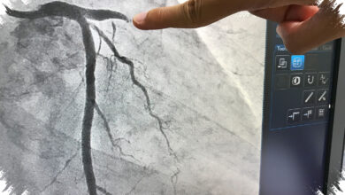 Lesi Bifurkasi Bikin Pemasangan Ring Jantung Lebih Rumit, Ini Alasan Dokter Menyesuaikan Teknik