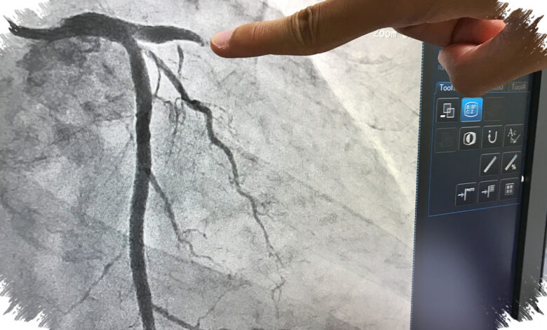 Lesi Bifurkasi Bikin Pemasangan Ring Jantung Lebih Rumit, Ini Alasan Dokter Menyesuaikan Teknik
