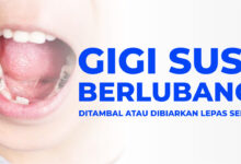 Gigi Susu Berlubang Bisa Mengacaukan Pertumbuhan Gigi Permanen Anak