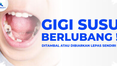 Gigi Susu Berlubang Bisa Mengacaukan Pertumbuhan Gigi Permanen Anak
