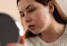 NaCl 0,9 Persen Aman untuk Wajah, tetapi Tak Terbukti Mengatasi Jerawat