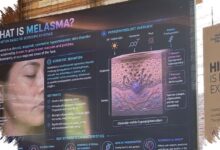 Melasma Mudah Berulang di Kulit Tropis, Tabir Surya Bukan Sekadar Pelengkap