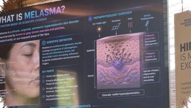 Melasma Mudah Berulang di Kulit Tropis, Tabir Surya Bukan Sekadar Pelengkap