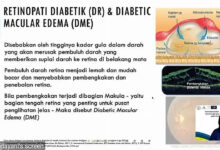 Kebutaan akibat Diabetes Bisa Dicegah, Namun Skrining Mata Sering Terlambat